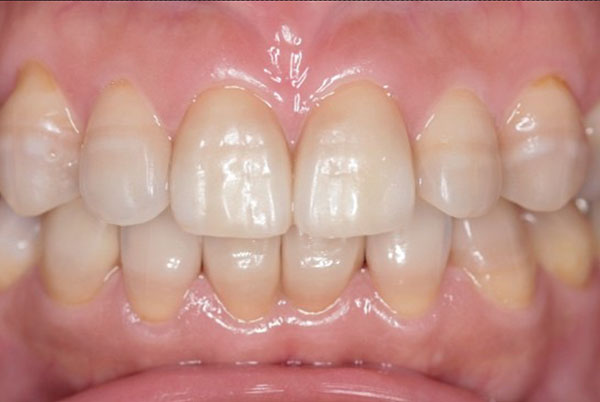 ２０代女性　ホワイトニングとセラミックで歯の色と形を改善した症例
