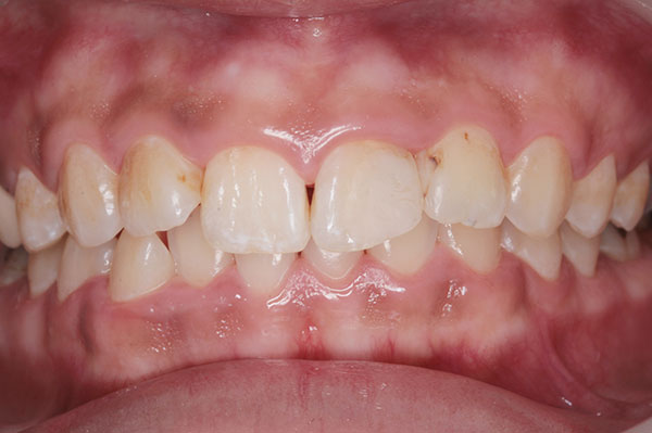 ２０代女性　ホワイトニングとセラミックで歯の色と形を改善した症例